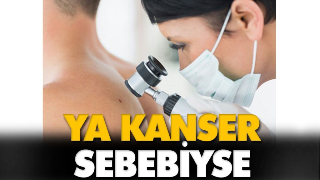 VÜCUDUNUZDAKİ BENLERE DİKKAT! VÜCUDUNUZDAKİ BENLERE DİKKAT!