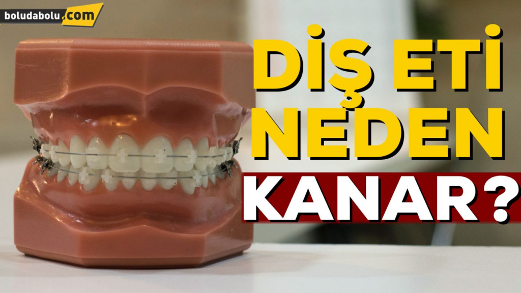 DİŞ ETİ NEDEN KANAR ? DİŞ ETİ NEDEN KANAR ?