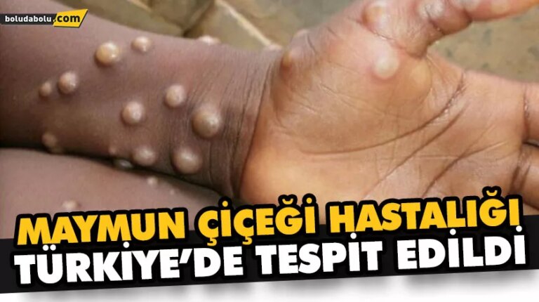 MAYMUN ÇİÇEĞİ HASTALIĞI TÜRKİYE’DE TESPİT EDİLDİ