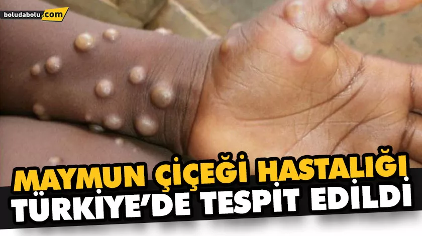 MAYMUN ÇİÇEĞİ HASTALIĞI TÜRKİYE’DE TESPİT EDİLDİ