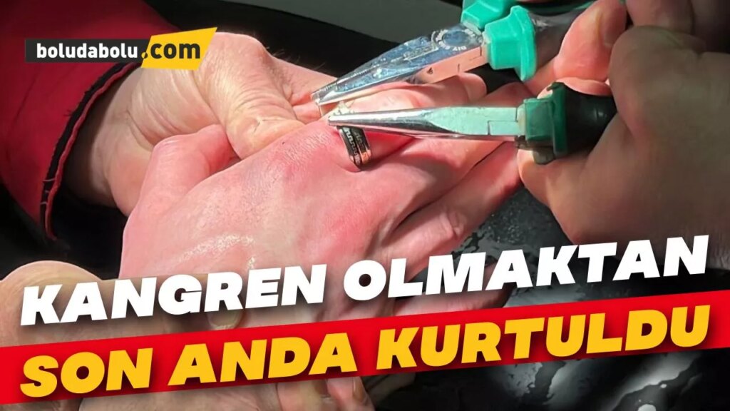 Kangren olmaktan son anda kurtuldu Kangren olmaktan son anda kurtuldu